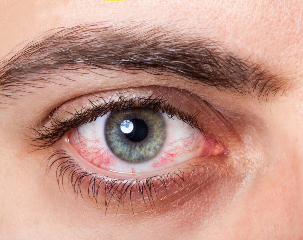czerwone oko sposoby na przekrwione oczy